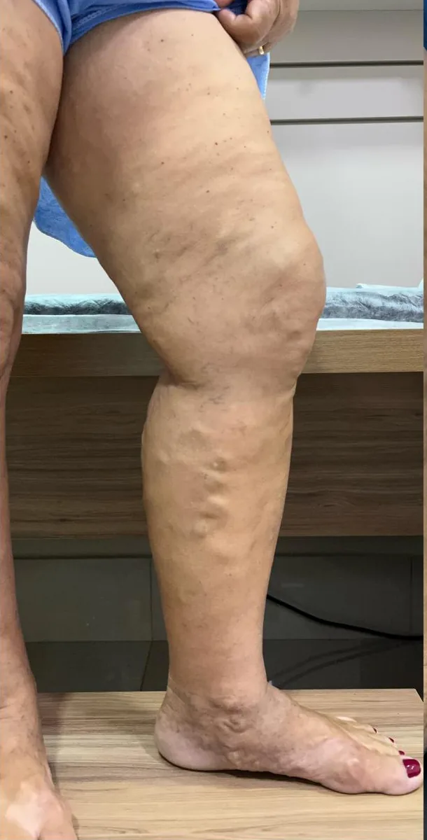 Perna com varizes em estágio avançado antes da cirurgia