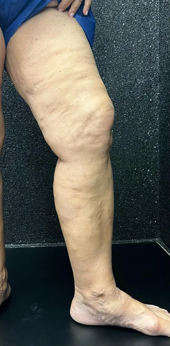 Mesma perna após cirurgia e acompanhamento pós-operatório