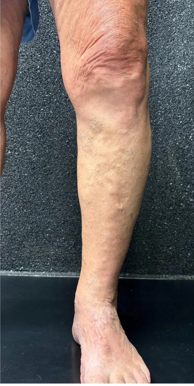 Mesma perna após ablação a laser endovenoso da safena
