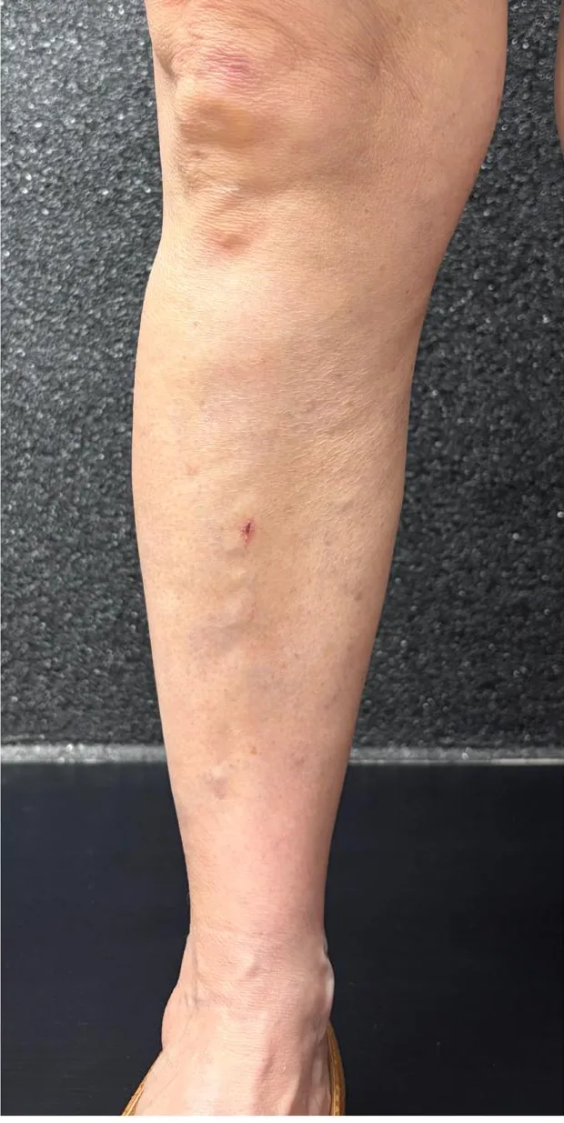 Mesma perna após flebectomia com laser endovenoso