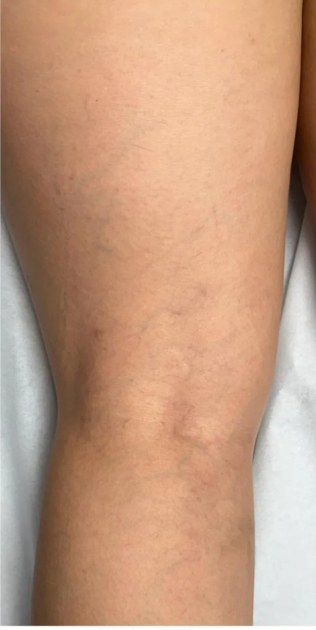 Mesma perna após escleroterapia com espuma